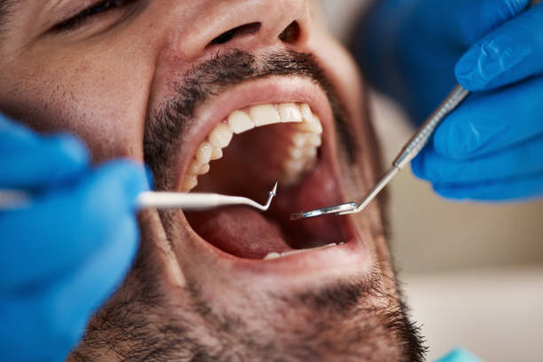 Best Emergency Tooth Extraction in Monroeville, AL