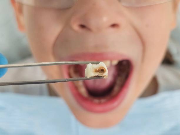 Best Emergency Treatment for Dental Infections or Abscesses in Monroeville, AL
